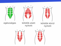 Minden, amit tudnod kell a szétnyílt hasizomról Minden, amit tudnod kell a szétnyílt hasizomról